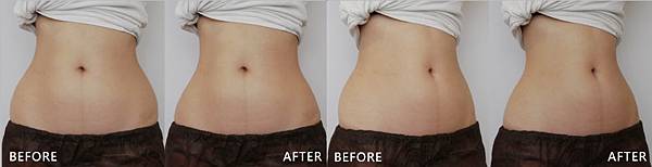 CoolSculpting-Yushan-ba CoolSculpting-Yushan-ba