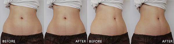 CoolSculpting-Yushan-ba