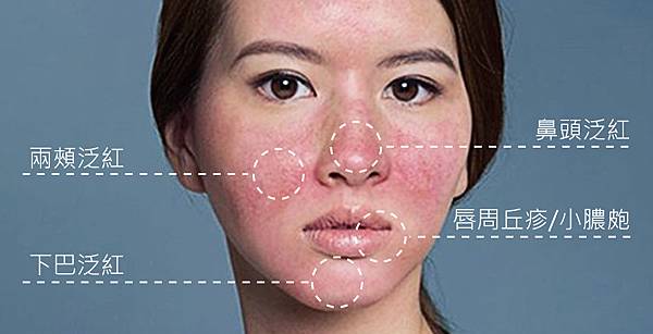 Doctor-Rosacea-2 Doctor-Rosacea-2