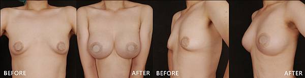 Breast augmentation-wen-4