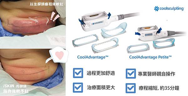 冷凍減脂CoolSculpting-mm-3 冷凍減脂CoolSculpting-mm-3