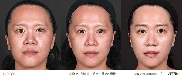 Hyaluronic-Evie-B-A Hyaluronic-Evie-B-A
