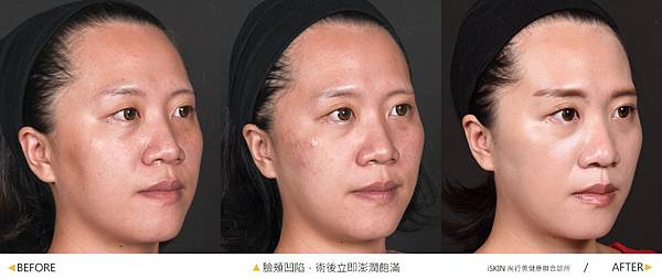 Hyaluronic-Evie-B-A-1 Hyaluronic-Evie-B-A-1