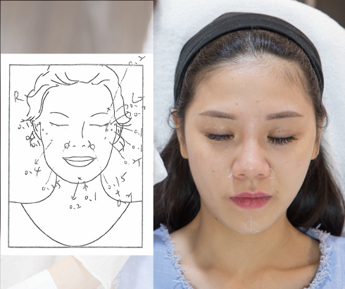 Hyaluronic+Botox-BABY-3-1