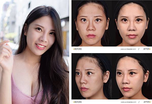 Hyaluronic+Botox-BABY-5 Hyaluronic+Botox-BABY-5