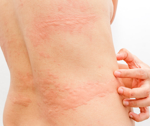 lu-top1health_Urticaria-3