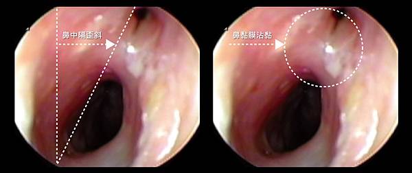 nose-Tsai-3 nose-Tsai-3