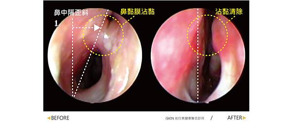 nose-Tsai-5 nose-Tsai-5