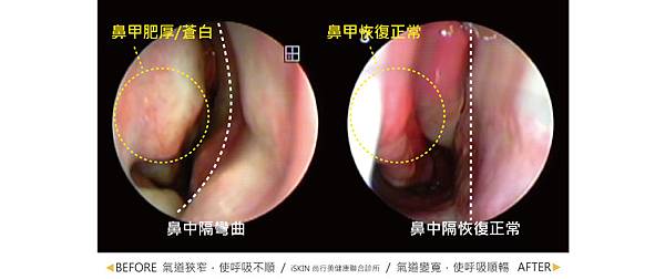 nose-STONE-5 nose-STONE-5