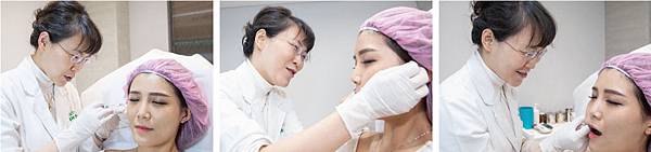 Hyaluronic+BOTOX-Katie-5 Hyaluronic+BOTOX-Katie-5