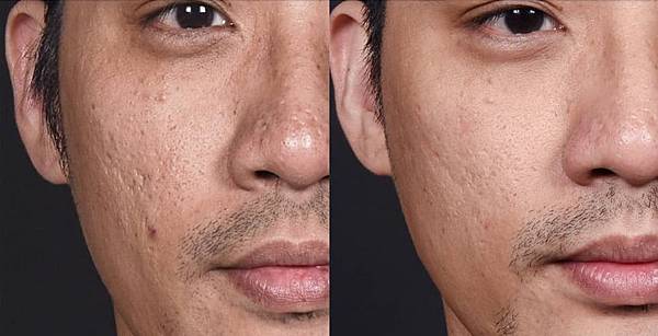 lu-linetoday_pimple-5 lu-linetoday_pimple-5