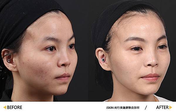 Sculptra_CANDY-7 Sculptra_CANDY-7