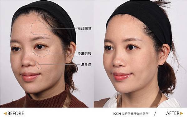 Hyaluronic-MEI-2 Hyaluronic-MEI-2