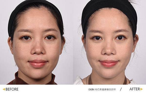 Hyaluronic-MEI-7 Hyaluronic-MEI-7