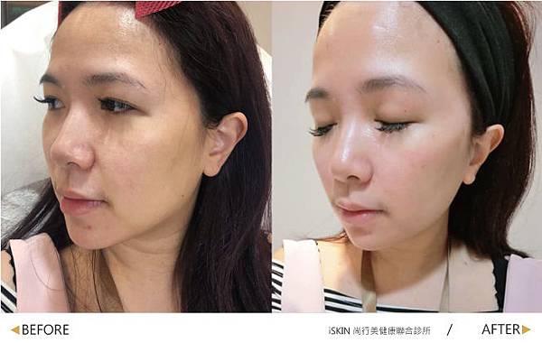 Hyaluronic-Yu Hyaluronic-Yu