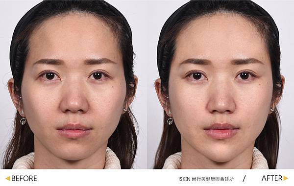 Hyaluronic-Cecilia-B-A(980) Hyaluronic-Cecilia-B-A(980)