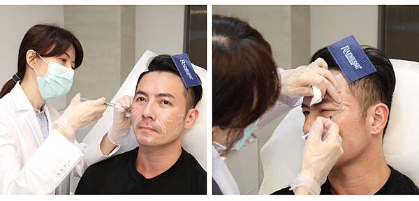 Hyaluronic+BOTOX-4 Hyaluronic+BOTOX-4