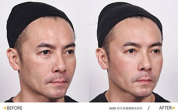 Hyaluronic+BOTOX-B-A Hyaluronic+BOTOX-B-A