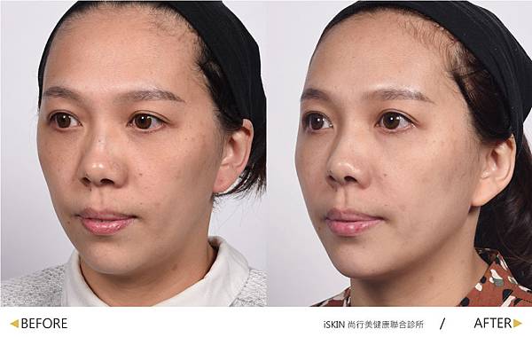 Hyaluronic-Alice-4 Hyaluronic-Alice-4