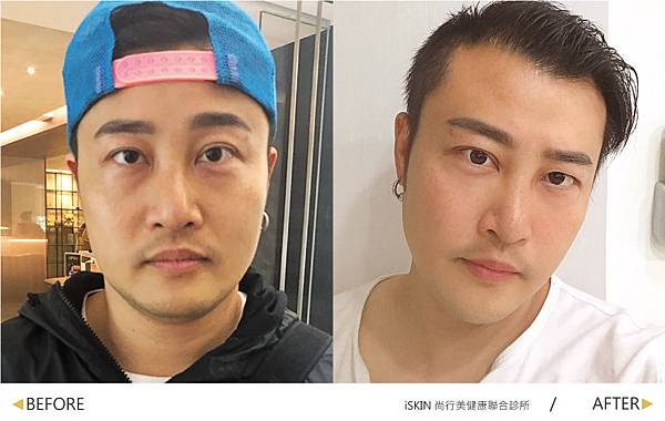 Hyaluronic+BOTOX-HONG-2 Hyaluronic+BOTOX-HONG-2