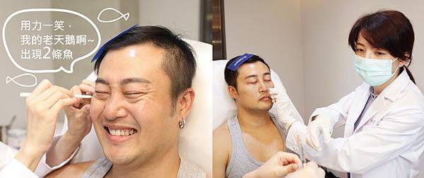 Hyaluronic+BOTOX-HONG-3 Hyaluronic+BOTOX-HONG-3