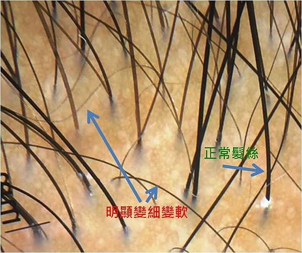 anisotrichosis 1.jpg