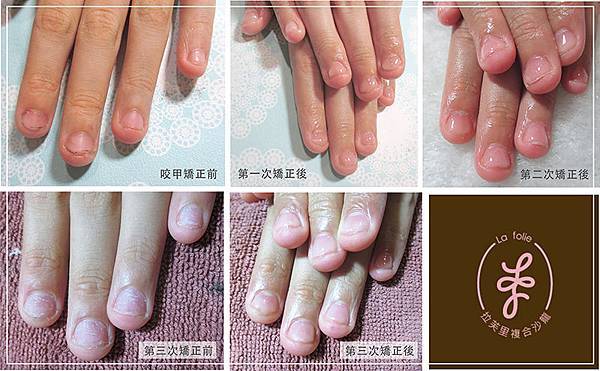 咬甲矯正_國一 咬甲矯正_國一