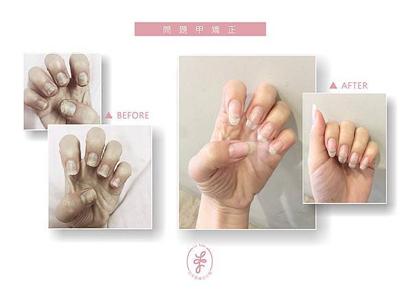 工作傷害指甲矯正 工作傷害指甲矯正