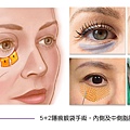 (4)5+2隱痕眼袋手術(眼袋推薦)-手術圖示.jpg