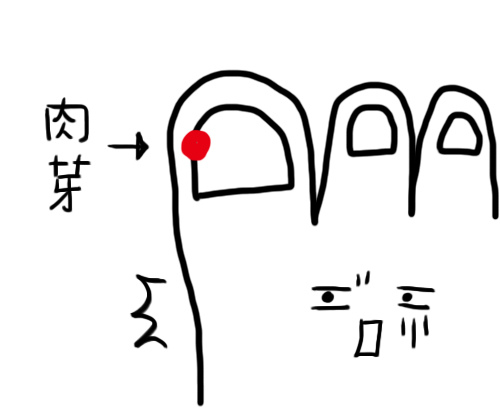肉芽.jpg 肉芽.jpg