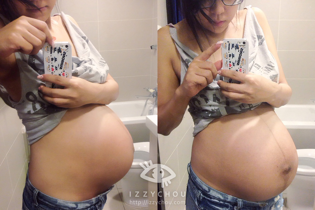 妊娠紋處理 妊娠紋處理