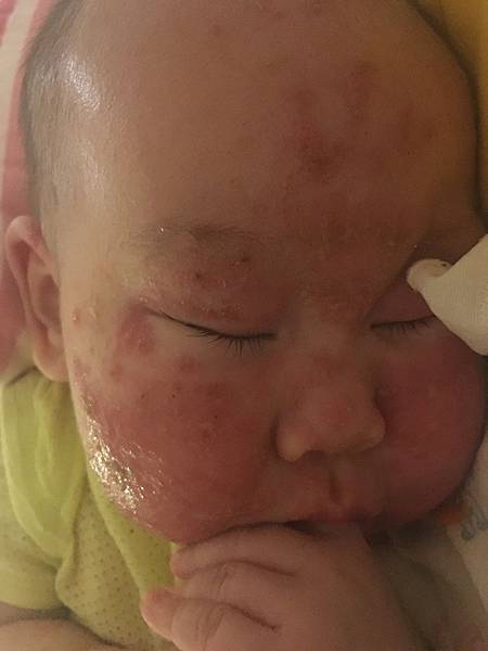 1070925寶寶濕疹異位性皮膚炎痊癒保濕乳液中醫不擦類固醇