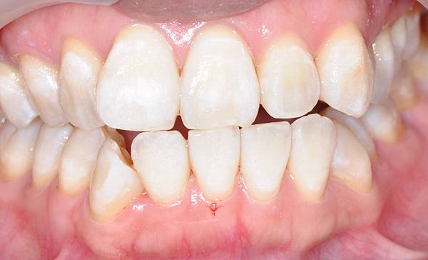 高雄牙醫/左營牙醫/牙醫推薦/高雄植牙