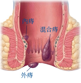 誅庤清 天然痔瘡藥， 幫助靜脈曲張，痔瘡痔核，內痔外痔