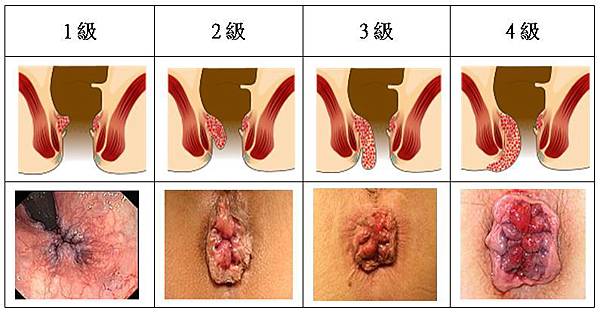 臨床上痔瘡組織靜脈瘤痔核嚴重程度作分級