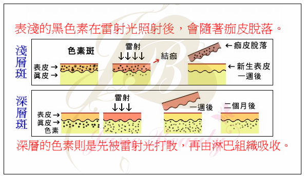 雷射除斑原理.jpg 雷射除斑原理.jpg