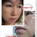 臉部使用前
