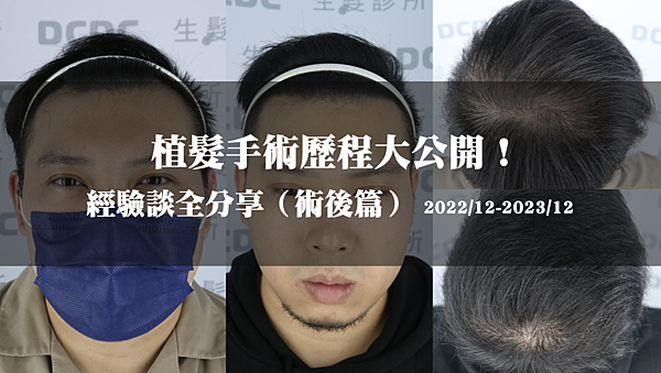 [植髮分享] Part 2 術後篇 手術歷程大公開,經驗
