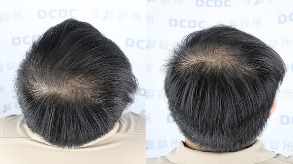 [植髮分享] Part 2 術後篇 手術歷程大公開,經驗