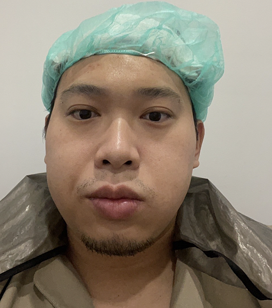 [植髮分享] Part 2 術後篇 手術歷程大公開,經驗