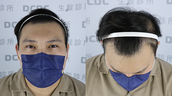 [植髮分享] Part 2 術後篇 手術歷程大公開,經驗