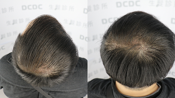 [植髮分享] Part 2 術後篇 手術歷程大公開,經驗