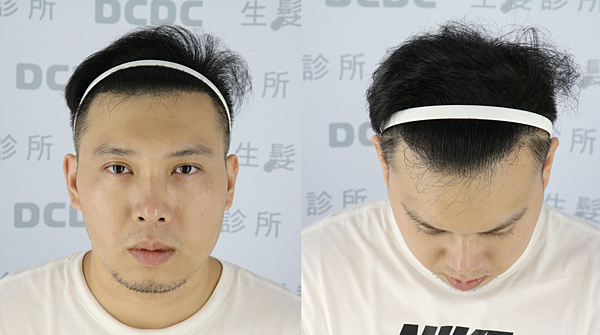 [植髮分享] Part 2 術後篇 手術歷程大公開,經驗