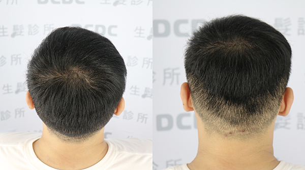 [植髮分享] Part 2 術後篇 手術歷程大公開,經驗