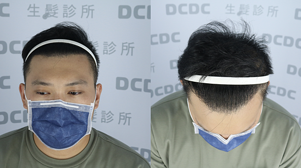 [植髮分享] Part 2 術後篇 手術歷程大公開,經驗