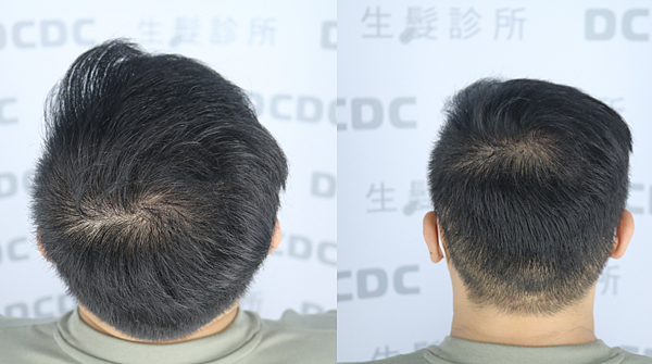 [植髮分享] Part 2 術後篇 手術歷程大公開,經驗