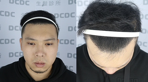 [植髮分享] Part 2 術後篇 手術歷程大公開,經驗