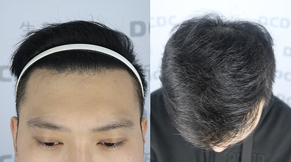 [植髮分享] Part 2 術後篇 手術歷程大公開,經驗