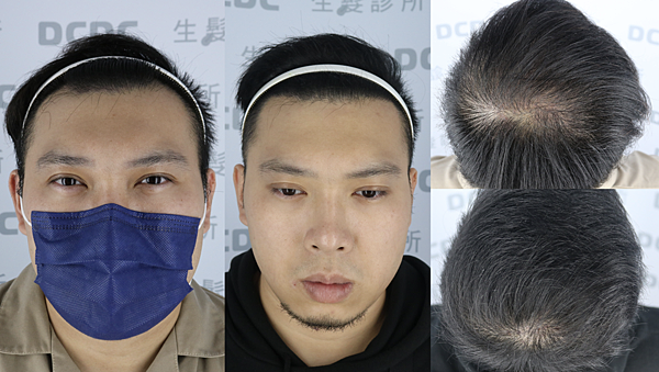 [植髮分享] Part 2 術後篇 手術歷程大公開,經驗