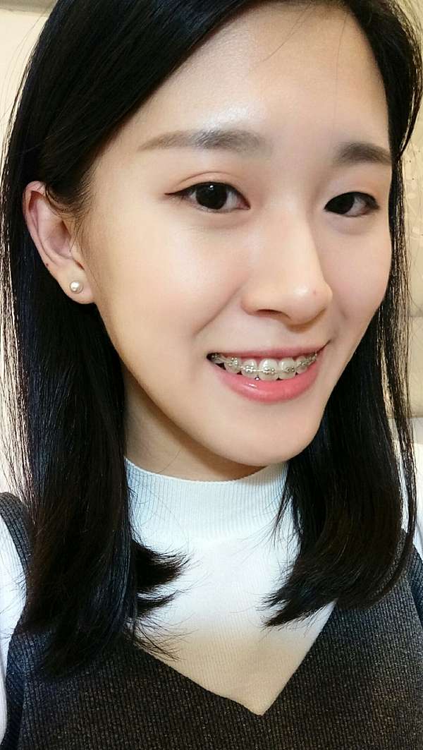 矯正滿一年半 上排門牙墊高 下排大臼齒墊高 中線對齊 珍妮的撐船之旅 痞客邦
